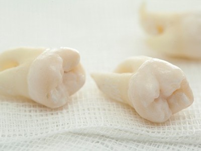 智齒疼了，這牙非拔不可嗎？