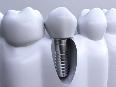 承德種植牙價格表，2024種植牙多少錢一顆呢?