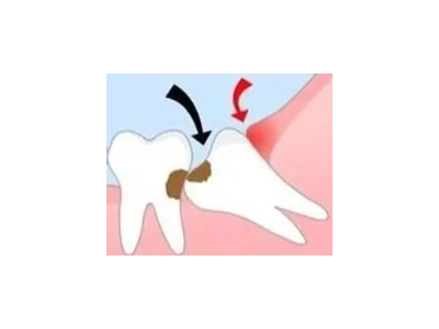 吃完飯后老塞牙？別大意！這可能是你的牙齒在報警