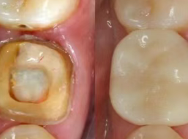 根管治療（抽神經）后，為什么一定要做牙冠？