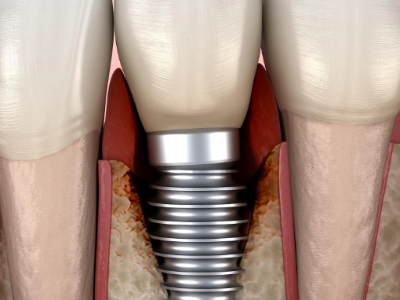 種植牙的術(shù)前準(zhǔn)備有哪些？