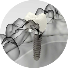 術(shù)前研究、模擬提升種植成功率