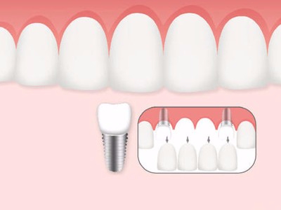 惟德口腔口腔種植怎么樣？惟德口腔就來為您一一解答