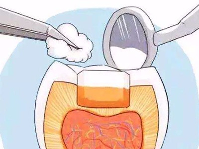 惟德口腔淺析在承德孩子牙齒蛀牙補(bǔ)牙需要多少錢