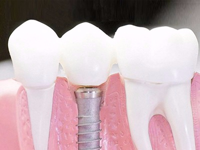 在承德口腔種植齒需要多少錢？惟德口腔一一為您道來